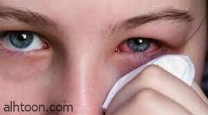 أعراض وأسباب حساسية العين خلال الصيف -صحيفة هتون الدولية-